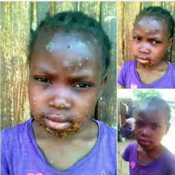 Girl Spotted With Symptoms Of Monkeypox In Kaduna (Photos)